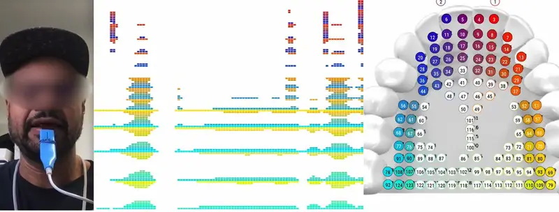 1641810389 199 This dental retainer uses your tongue to send messages without