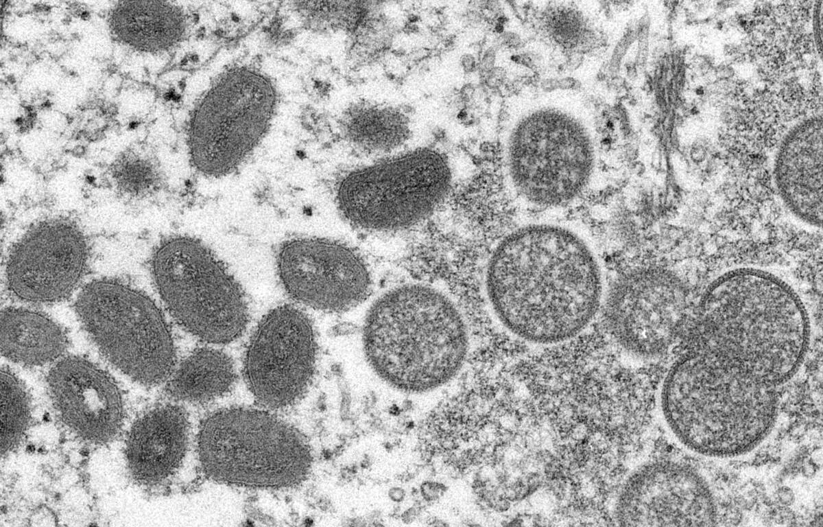 First case of monkeypox detected in Israel
