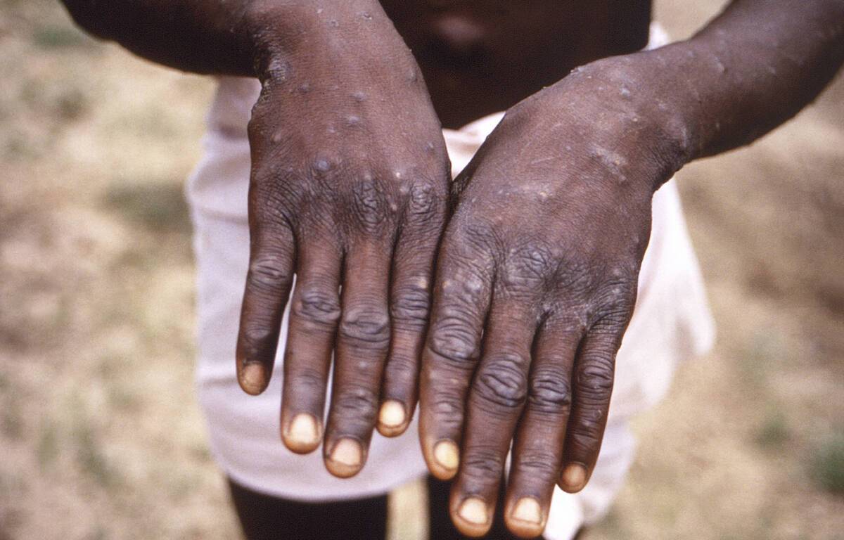Soon PCR tests for monkeypox
