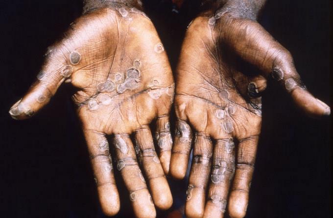 Portugal borders on 300 cases of monkeypox


