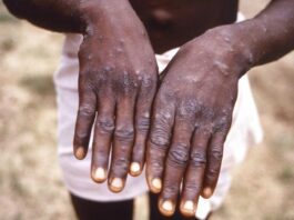 África dice tratar brote de viruela símica como emergencia