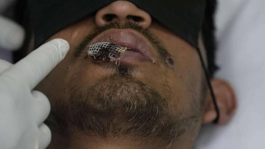 Monkeypox - India TV Hindi News