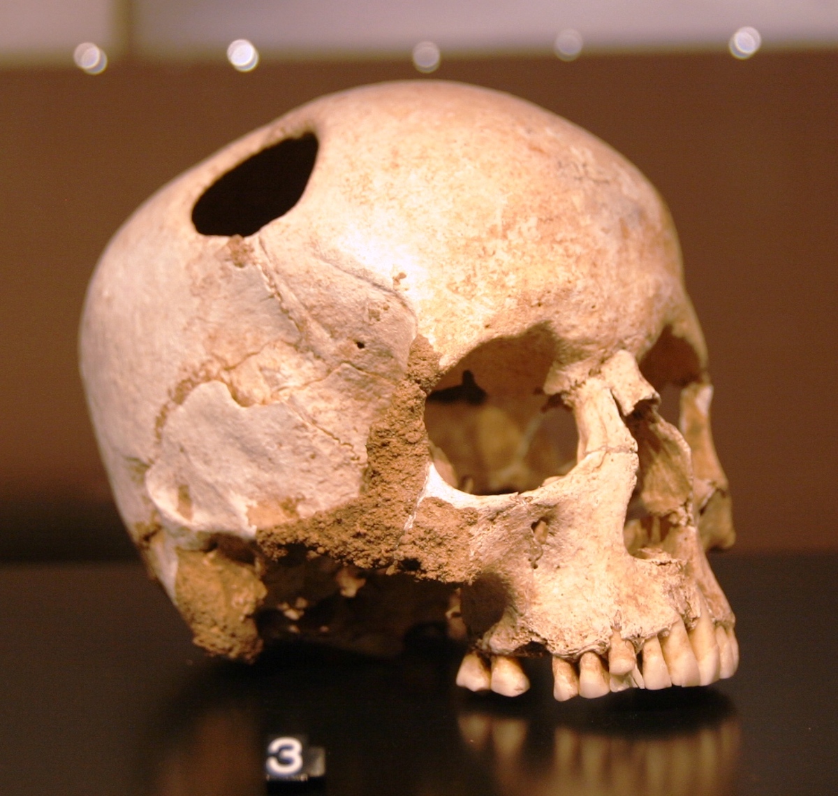 Brain surgery that humans practiced 5,000 years ago

