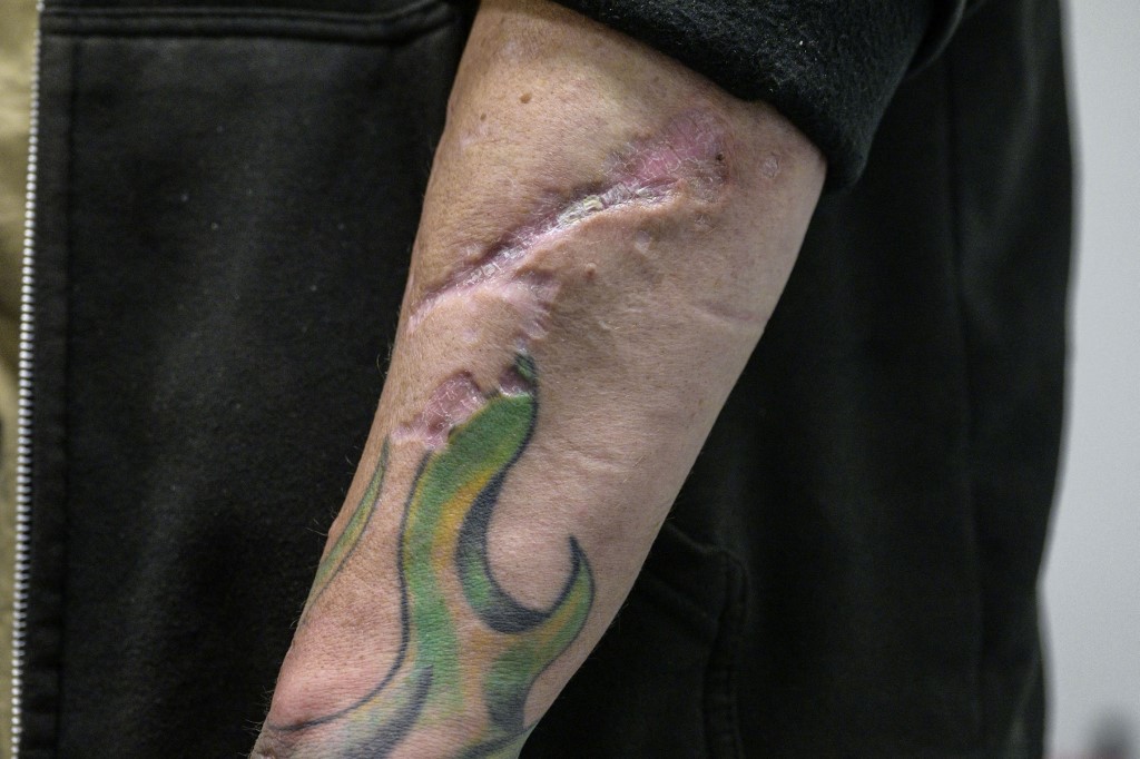 Heroin user Martin, 45, shows his scars from drug use at the Santa Ana Harm Reduction Corner in New York on May 25, 2023.