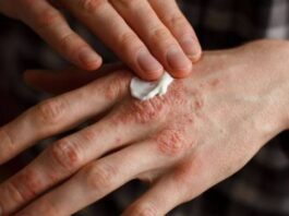 Patients with severe psoriasis have an increased cardiovascular risk

