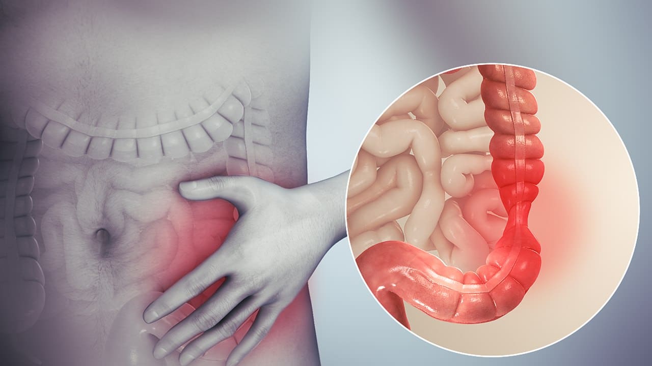 FODMAP diet more effective than irritable bowel syndrome medications


